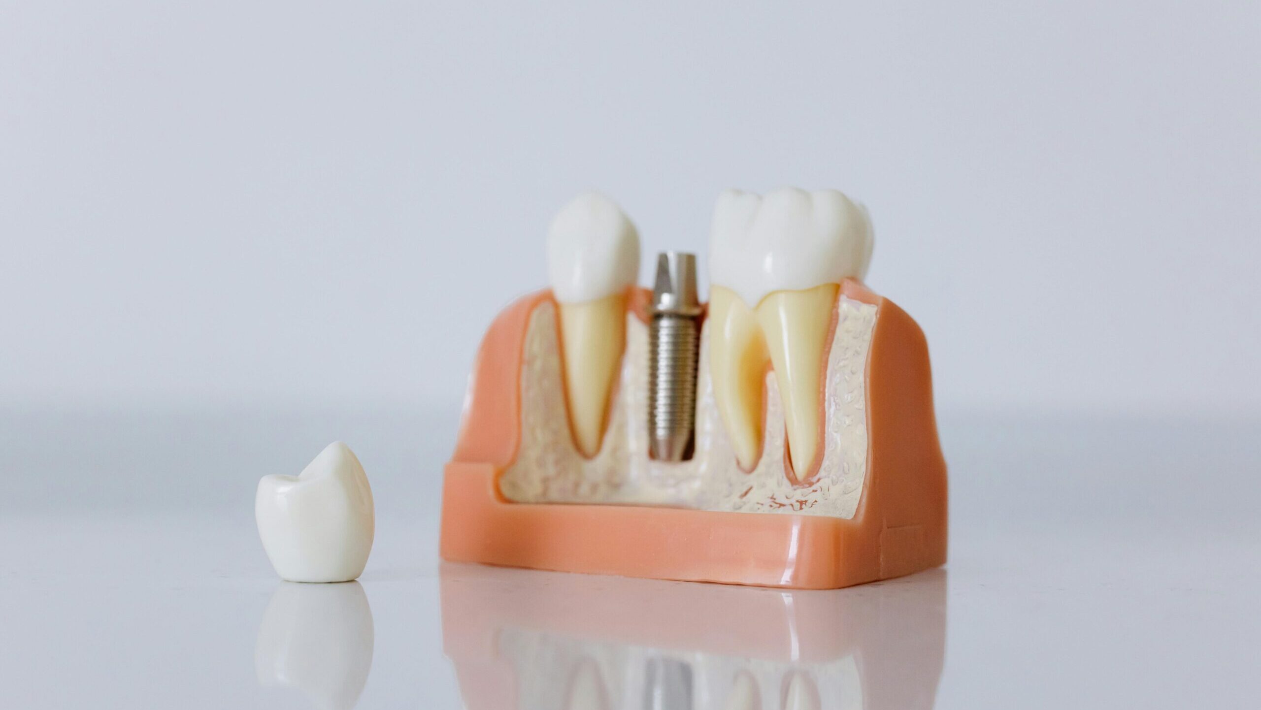 Detalle del tratamiento de implantes dentales en nuestra clínica dental de Vallecas